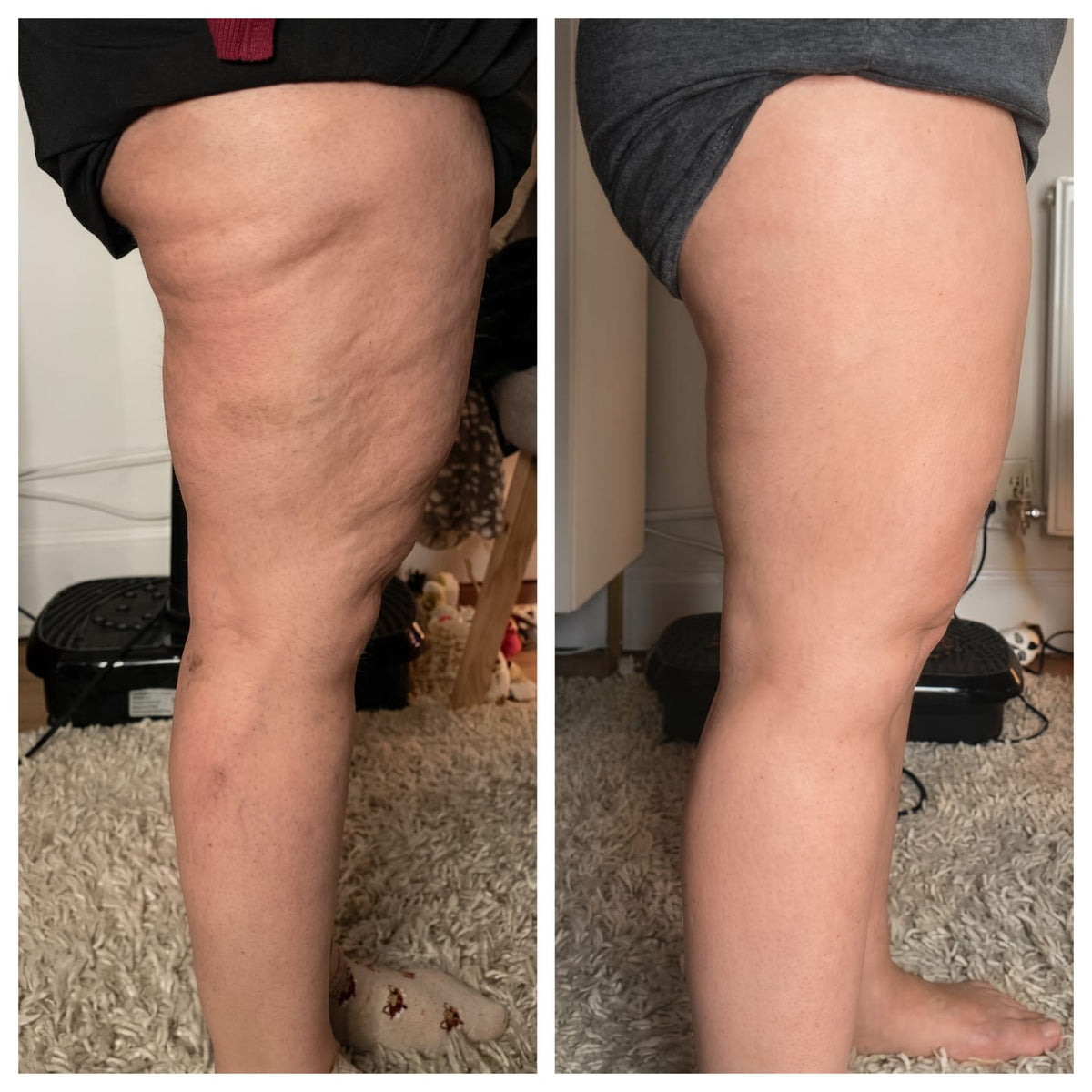 Celluglow body sculpt: cellulite apparaat voor thuis